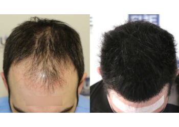 Best Hair Transplant Surgeons In Jalandhar Expert Recommendations