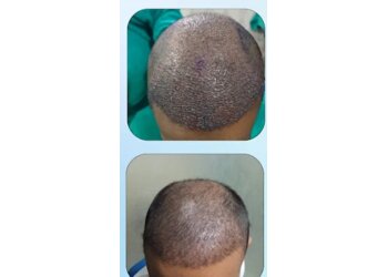 Apex Hair Transplant