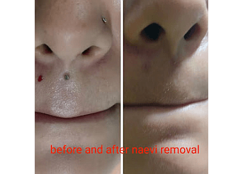 Dr. Ankit M Saxena, MBBS, MD - SAXENA'S SKIN, HAIR & COSMETIC CENTRE