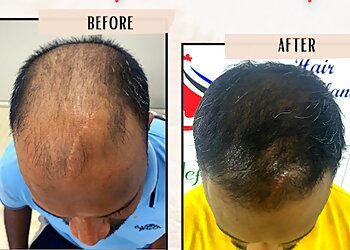 Dr. Jude Dileep, MBBS, MD, DNB (DVL) - DR. JUDE'S HAIR TRANSPLANT AND SKIN CLINIC