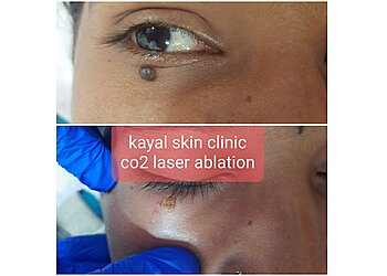 Dr. Nandhini P, MBBS, MD - KAYAL SKIN CLINIC