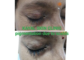 Dr. Nandhini P, MBBS, MD - KAYAL SKIN CLINIC
