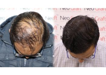 Dr. Nav Vikram, MBBS, FCCS, IAAM, MISHRS - NEOGRAFT HAIR CLINIC