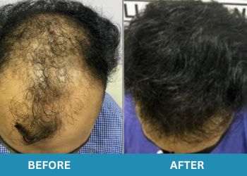 Dr. Sandeep Mahapatra, MBBS, MD (DVL) - NEO FOLLICLE TRANSPLANT