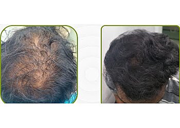 Ultra Bio Hair Transplant Clinic